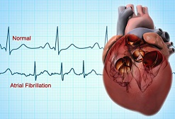 Atrial