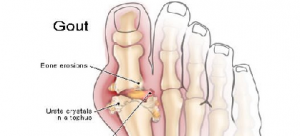 Gout